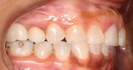 After treatment - patient 81