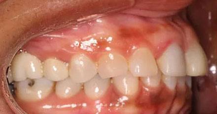 Before treatment - patient 81