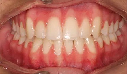 After treatment - patient 82