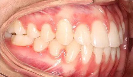 After treatment - patient 83