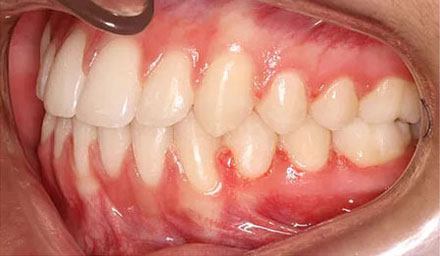After treatment - patient 84