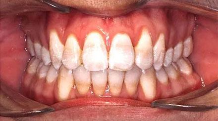 After treatment - patient 85
