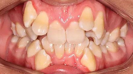 Before treatment - patient 85