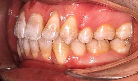 After treatment - patient 86