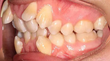 Before treatment - patient 86