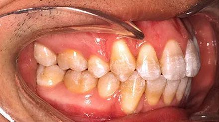 After treatment - patient 87