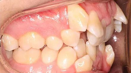 Before treatment - patient 87