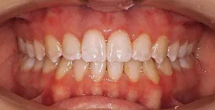 After treatment - patient 88
