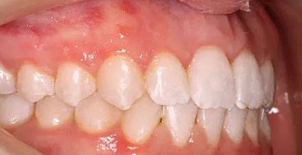 After treatment - patient 89