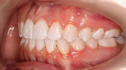After treatment - patient 90