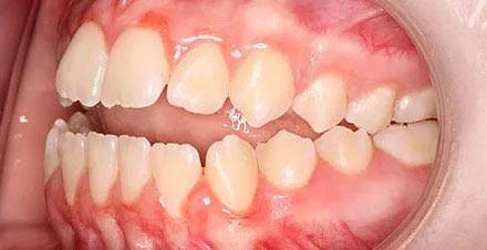 Before treatment - patient 90