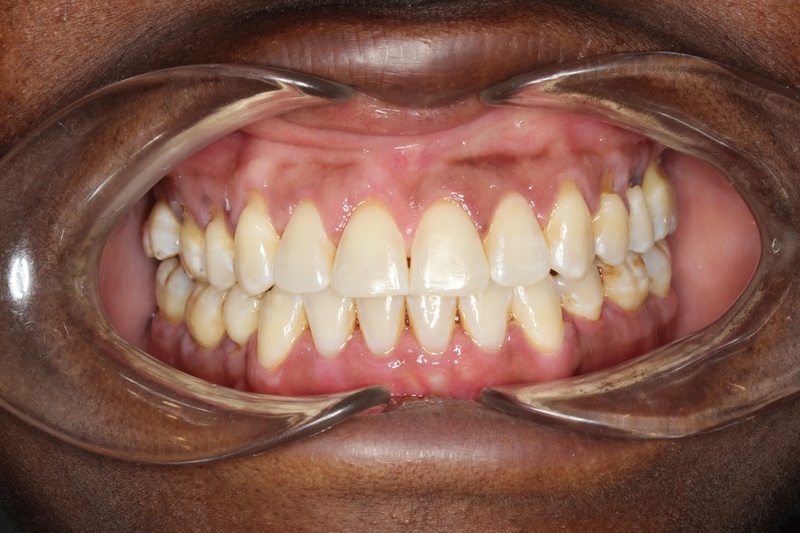 After treatment - patient 91