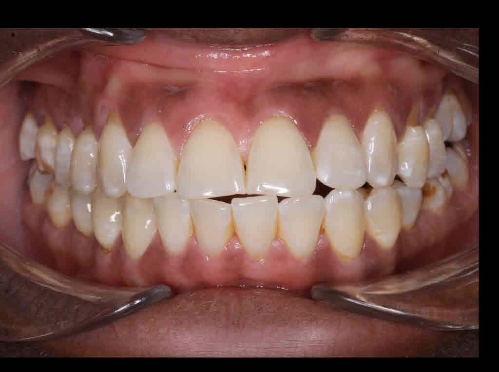 Before treatment - patient 91