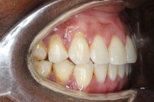 After treatment - patient 92