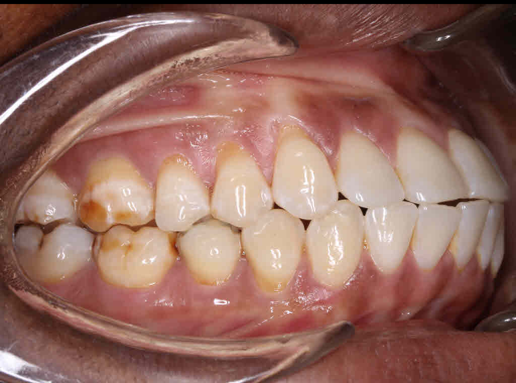 Before treatment - patient 92
