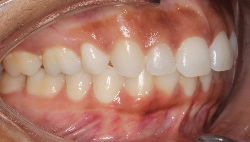 After treatment - patient 93