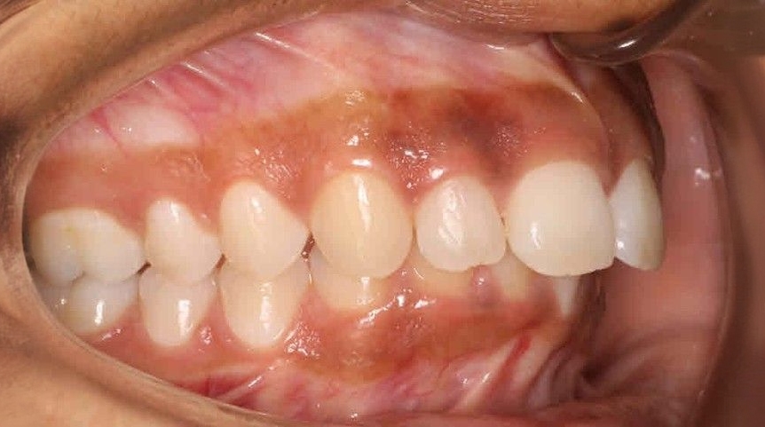 Before treatment - patient 93