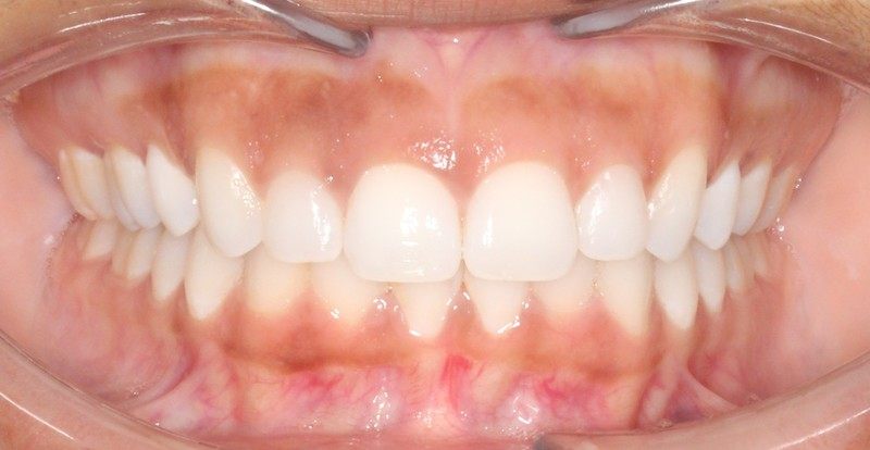 After treatment - patient 94