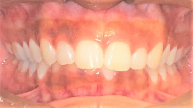 Before treatment - patient 94
