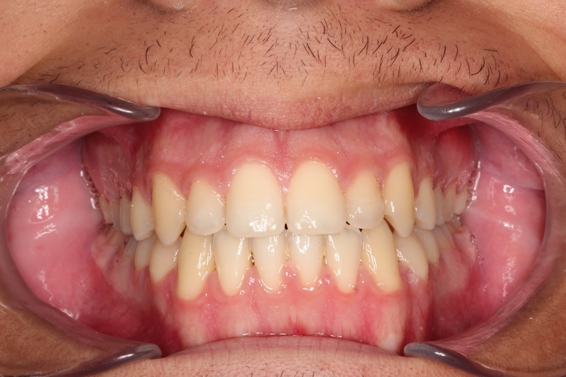 After treatment - patient 95