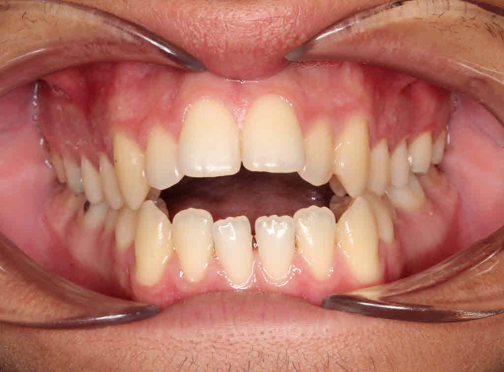 Before treatment - patient 95