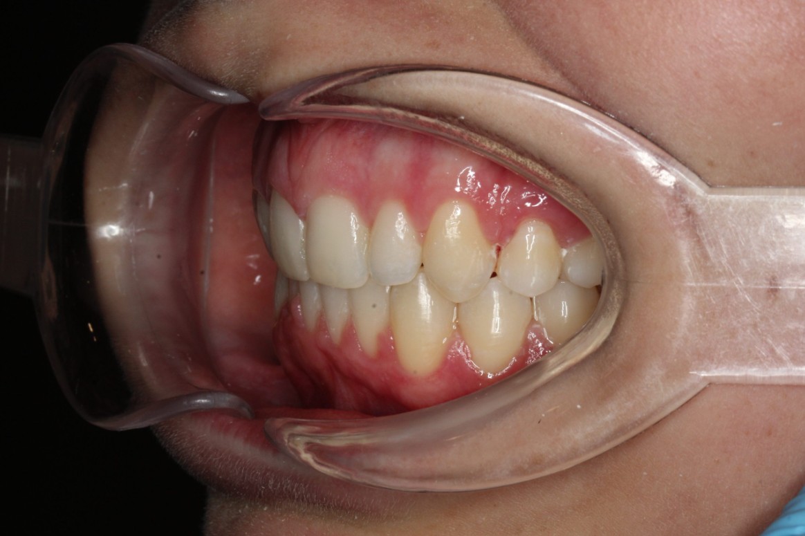 After treatment - patient 97
