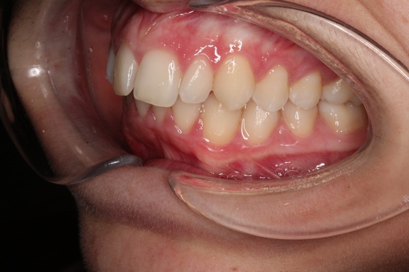 Before treatment - patient 97