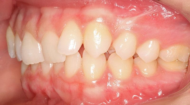 Before treatment - patient 12