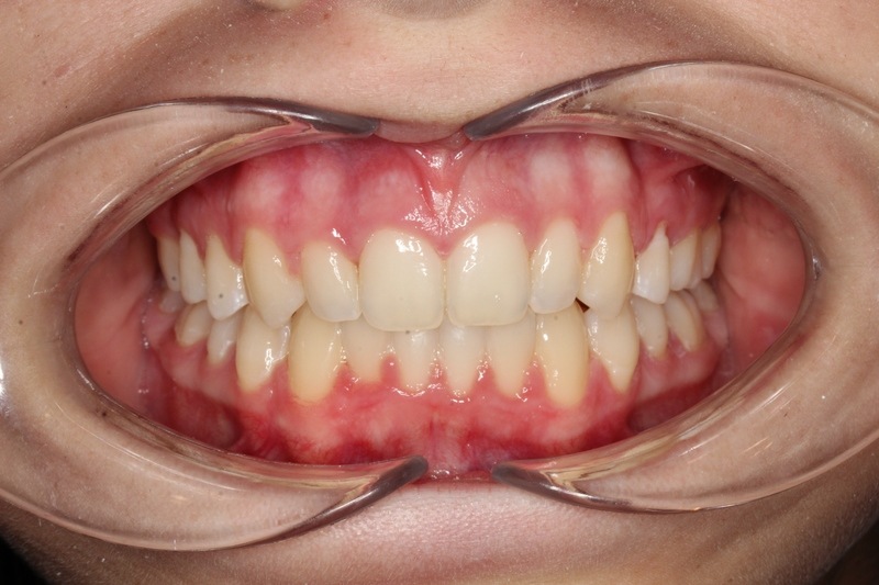 After treatment - patient 98