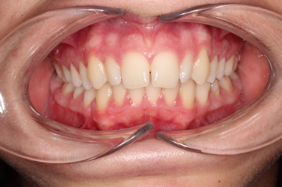 Before treatment - patient 98
