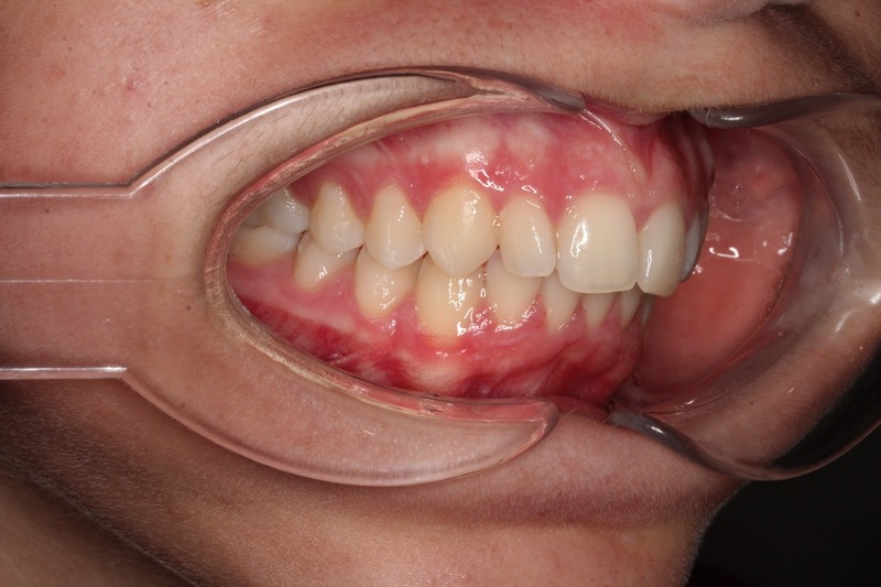 Before treatment - patient 99