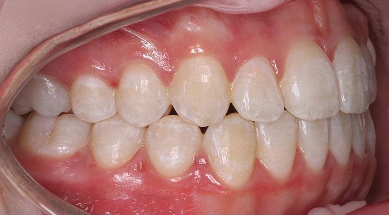 After treatment - patient 30