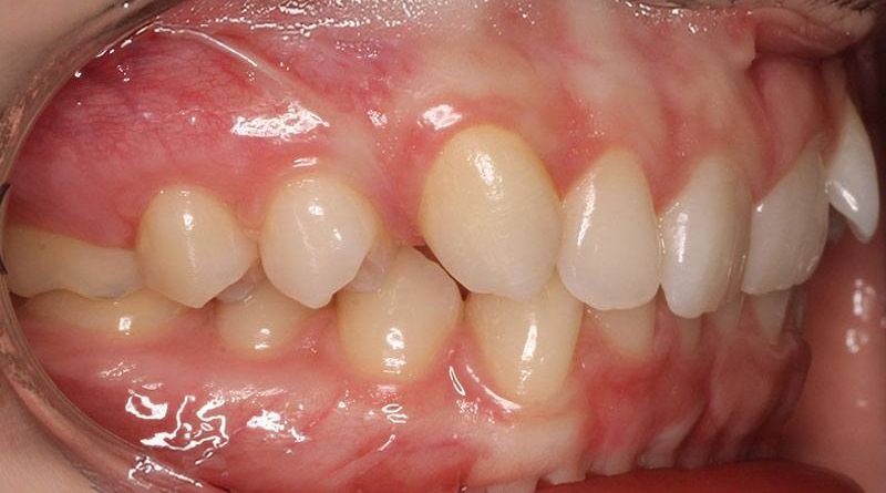 Before treatment - patient 11