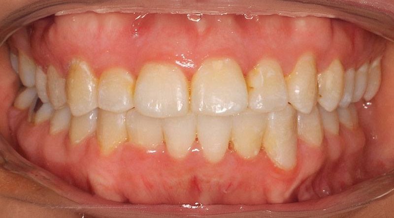 After treatment - patient 1