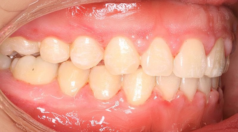 After treatment - patient 18