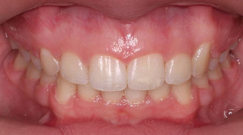 After treatment - patient 33