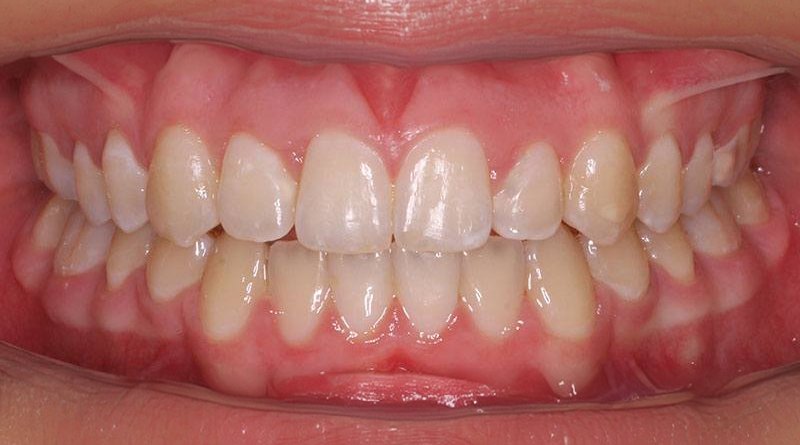 After treatment - patient 2