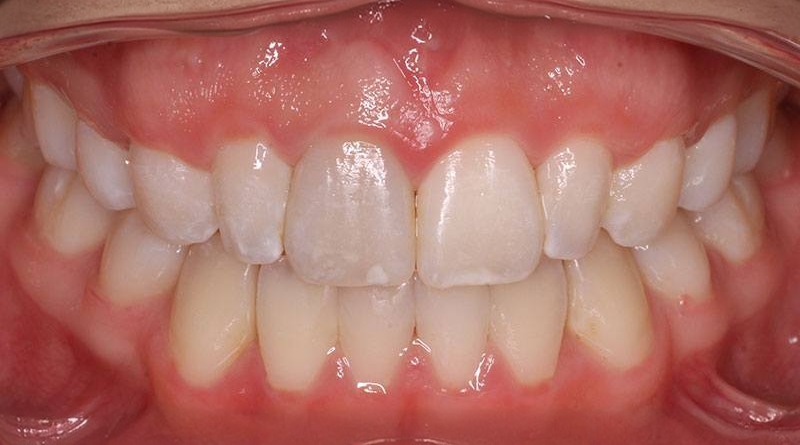 After treatment - patient 36