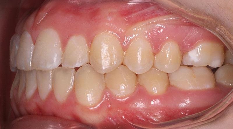 After treatment - patient 4