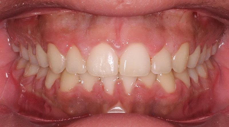 After treatment - patient 5