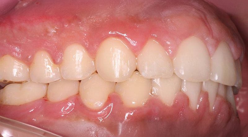 After treatment - patient 6