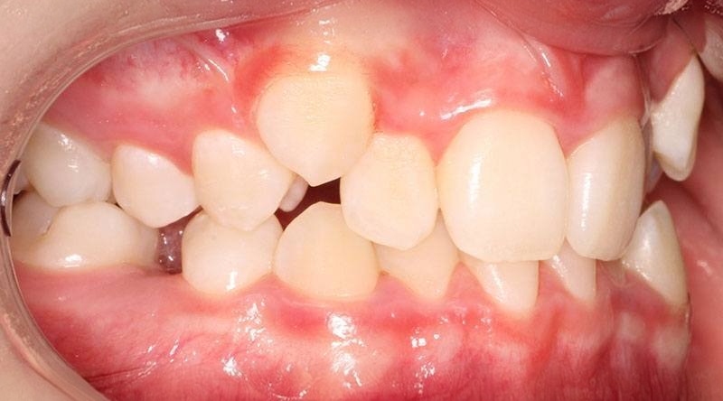 Before treatment - patient 30