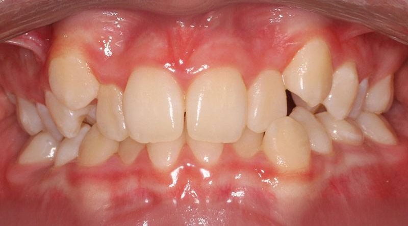 Before treatment - patient 29