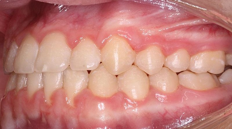 After treatment - patient 21