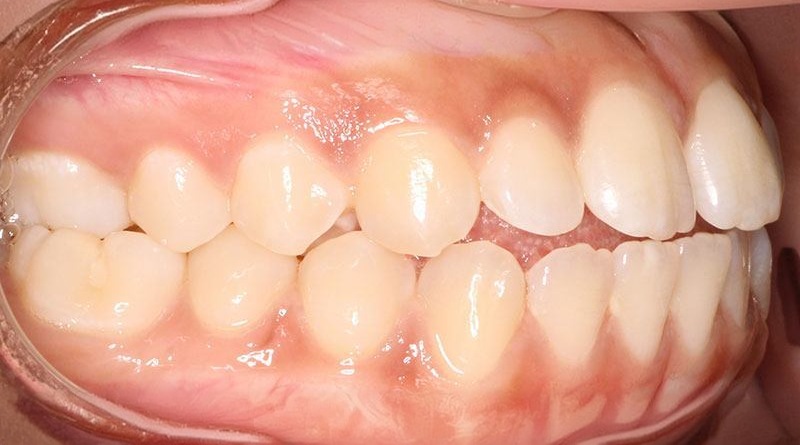 Before treatment - patient 26