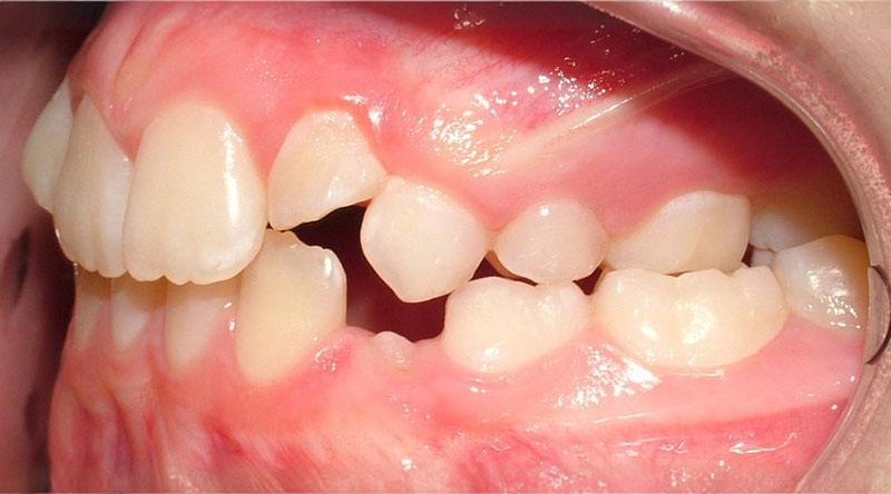 Before treatment - patient 4