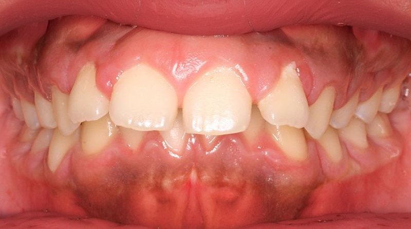 Before treatment - patient 5