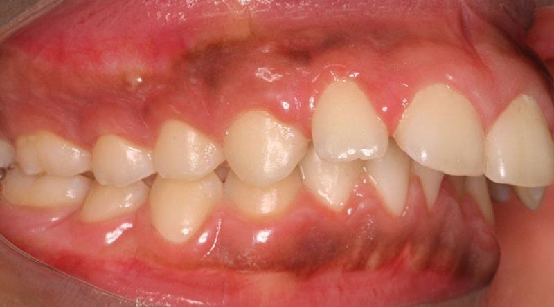 Before treatment - patient 6