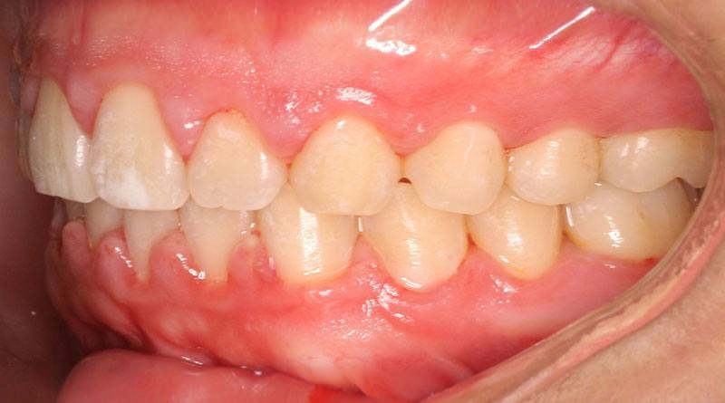 After treatment - patient 19