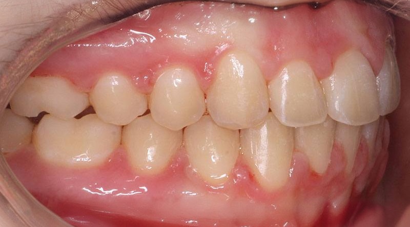 After treatment - patient 15